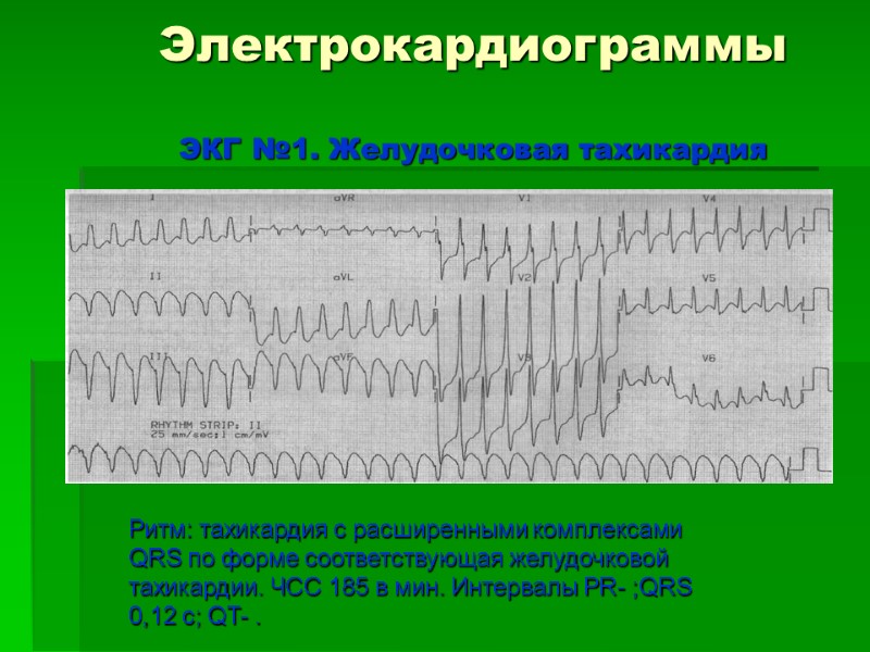 Электрокардиограммы  ЭКГ №1. Желудочковая тахикардия        